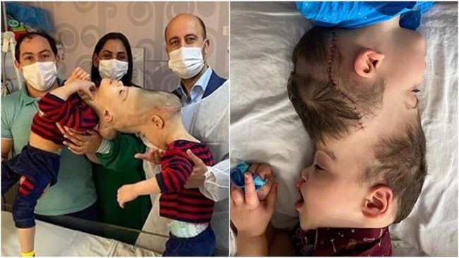 Brazilian twins who were joined at the head have been successfully separated with the help of a British neurosurgeon.

Bernardo and Arthur Lima, who were born with fused brains, underwent several operations in Rio de Janeiro, with the direction of Great Ormond Street Hospital paediatric surgeon Noor ul Owase Jeelani.