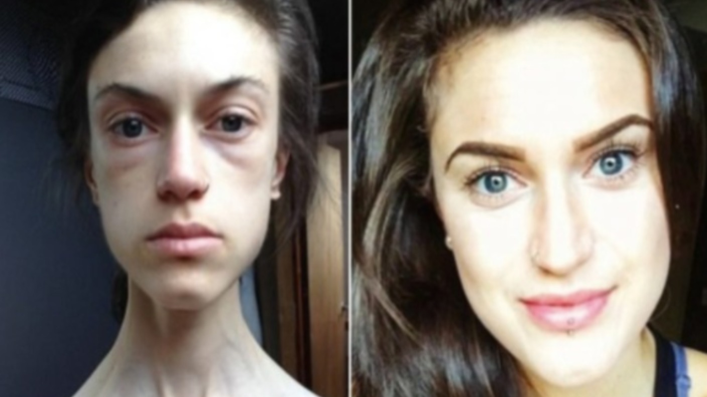 anorexia before and after pictures of people with anorexia