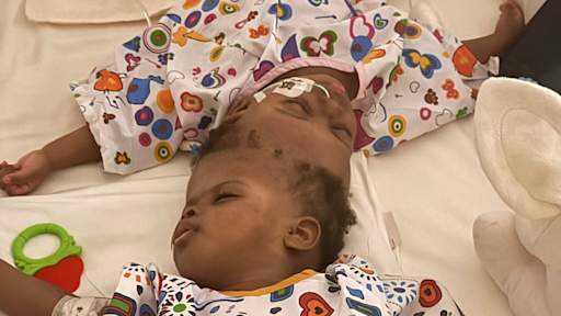 Conjoined twins separated after 40 hours of operations