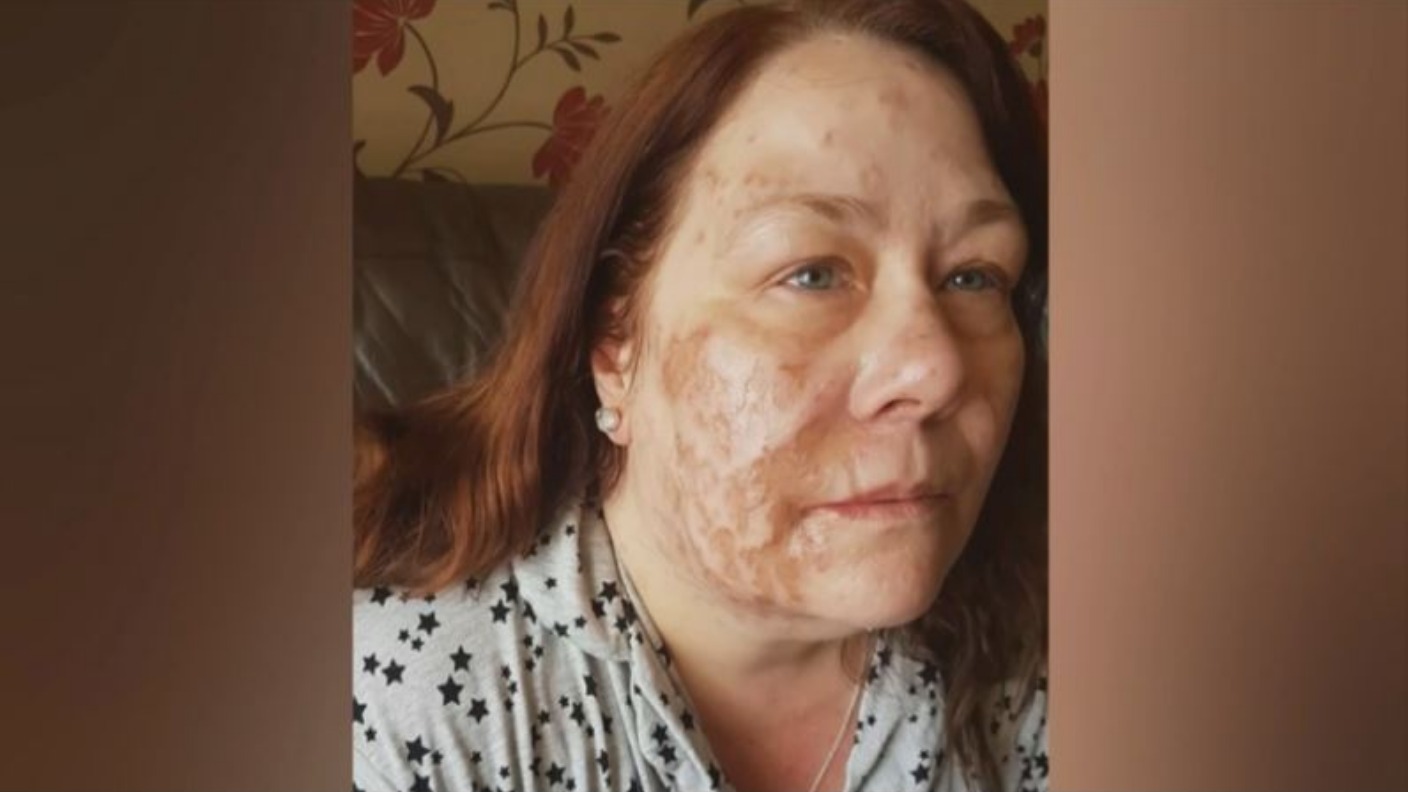 Sister of acid attack victim urges for more control on sale of ...