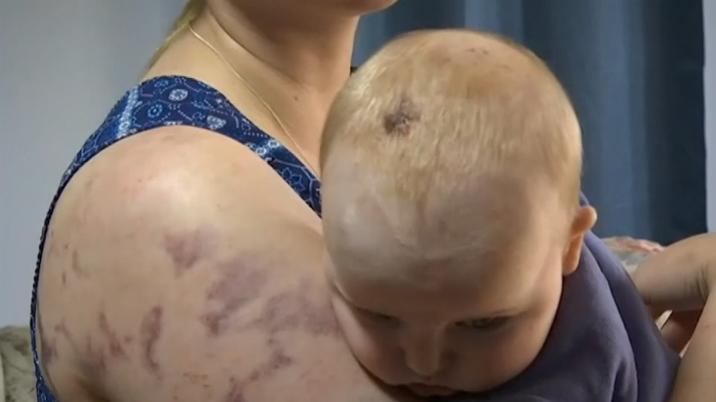 Mother and baby left battered and bruised after a ferocious hailstorm ...