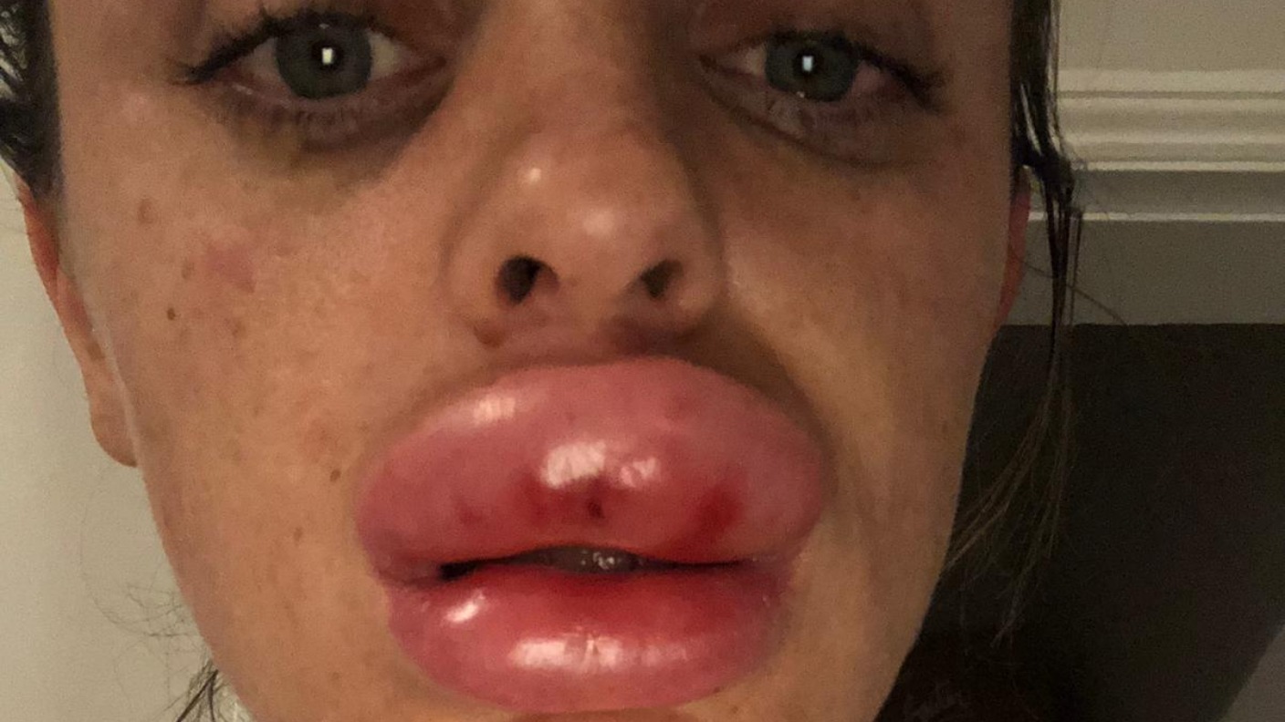 Warning After Lip Filler Injection Goes Wrong Itv News Central