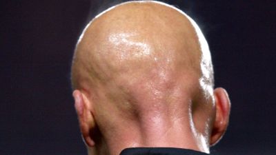 Bald men have 'higher risk of developing heart disease' | ITV News