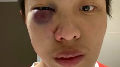 Student hit by attacker who said: 'I don't want your coronavirus in my country' (FACEBOOK)