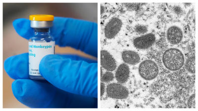 A split image of a monekypox vaccine a microscopic image of monekypox infection. 