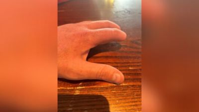 Tom Matthews' fingers following a workplace accident