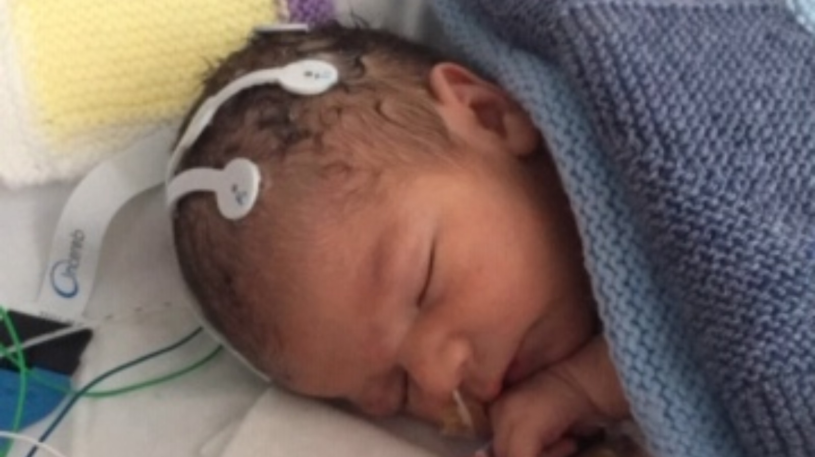 A Norfolk newborn first baby in the world to get cannabisbased