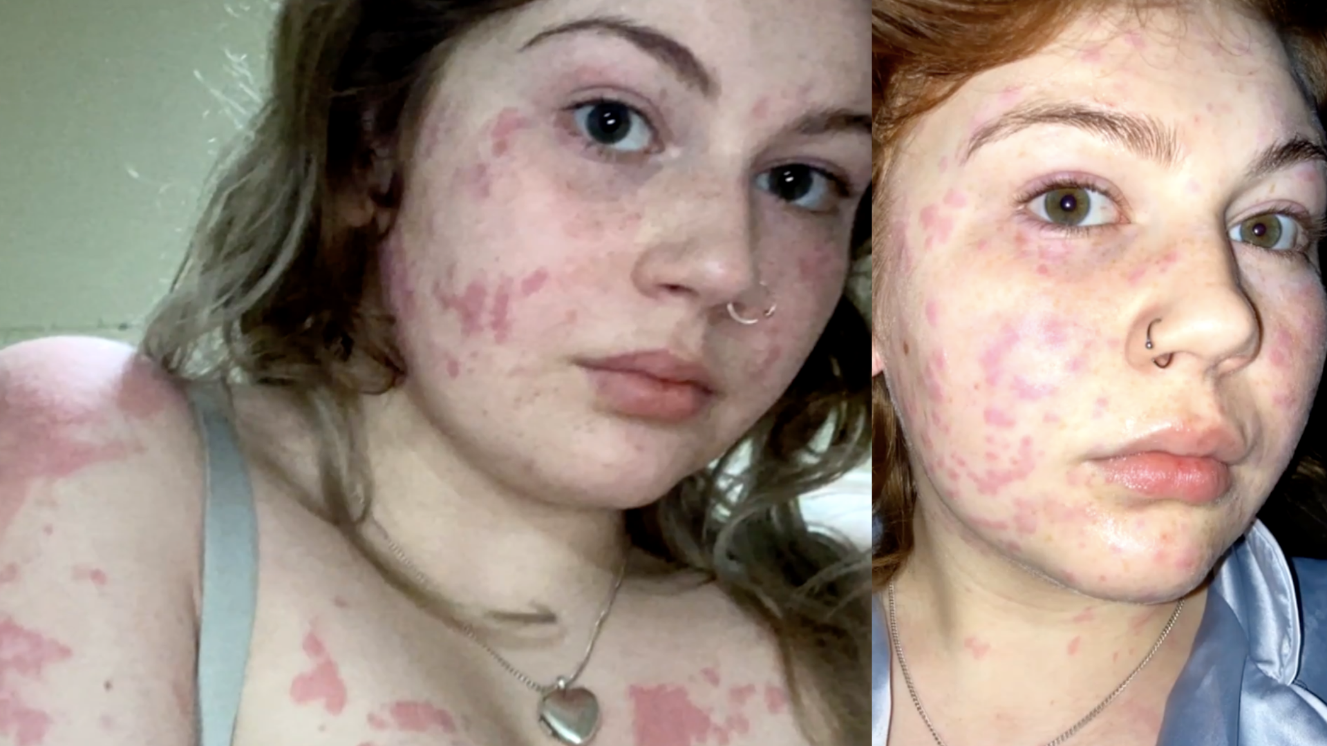 Black Mold Skin Rash