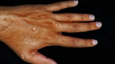 Monkeypox blisters on a hand