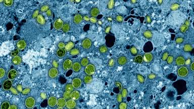 Newly evolved variant of mpox identified by England health officials