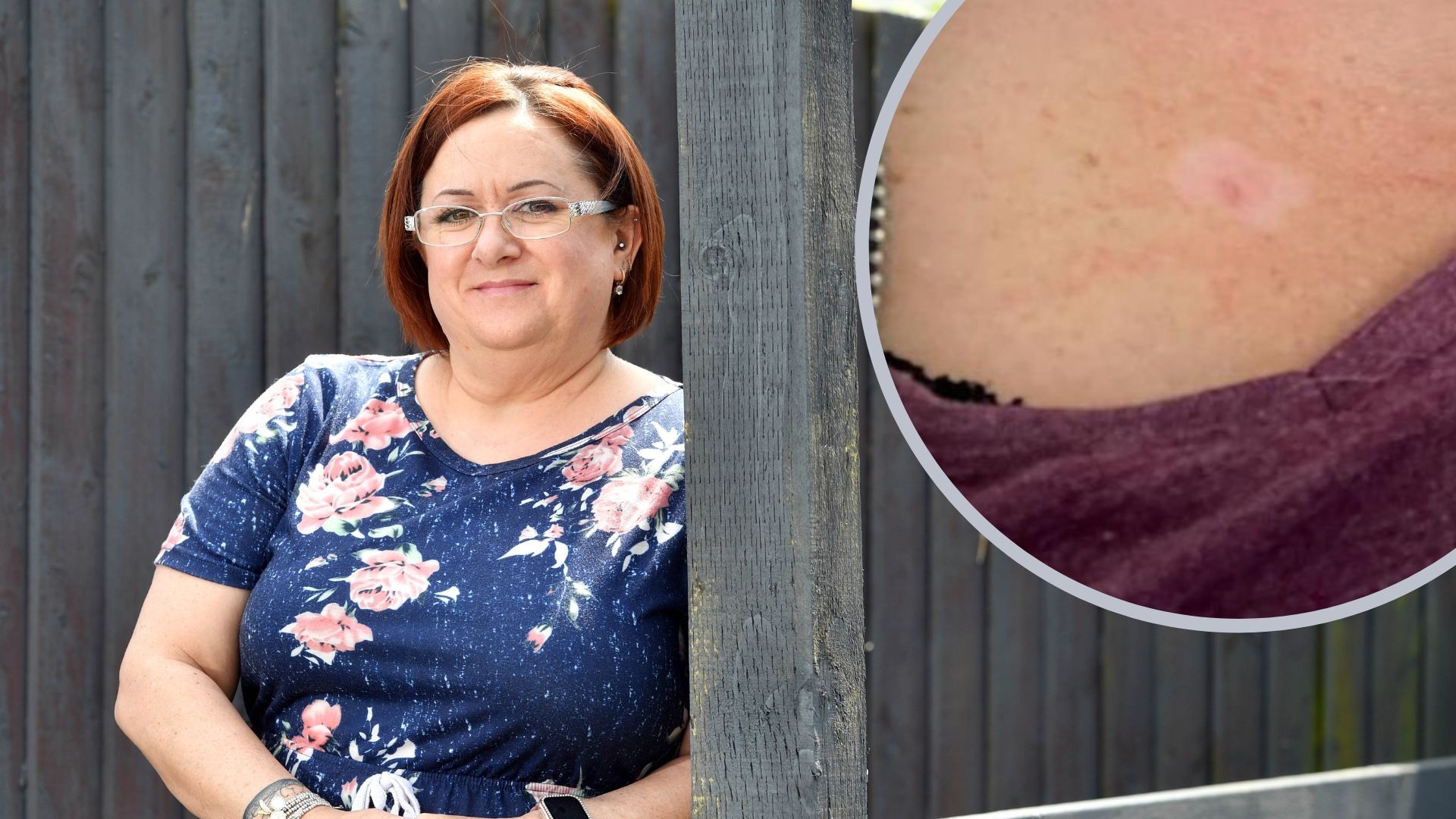 Nurse from Barry shocked after 'small red lump' on chest became stage 2 ...