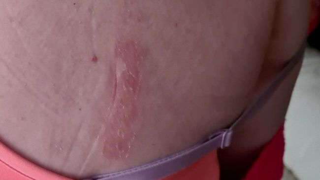 Primark shopper says bra left her with painful and irritated skin