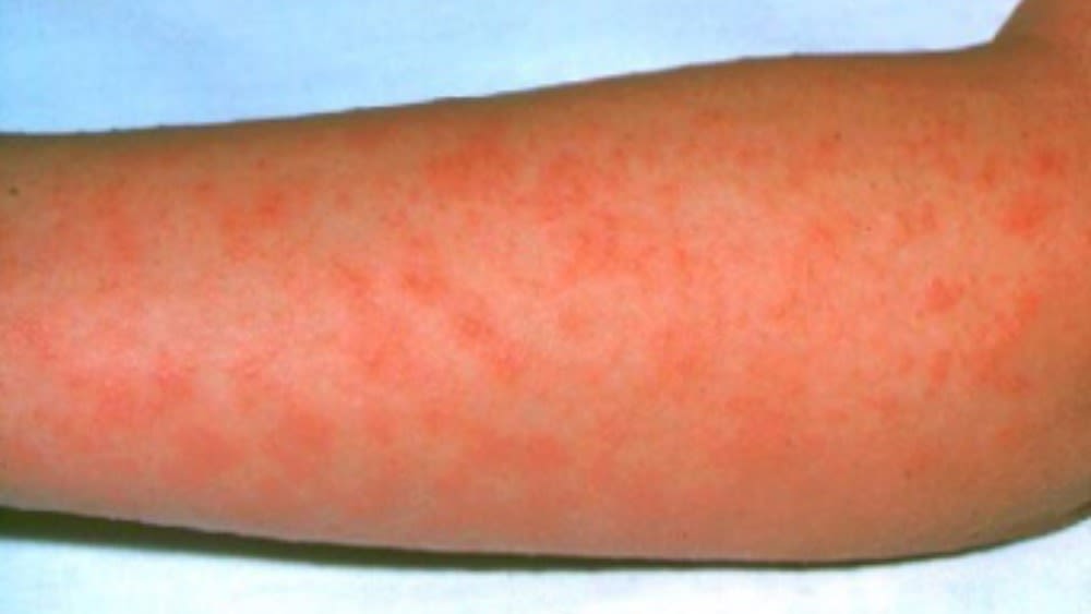 Scarlet Fever: All You Need to Know