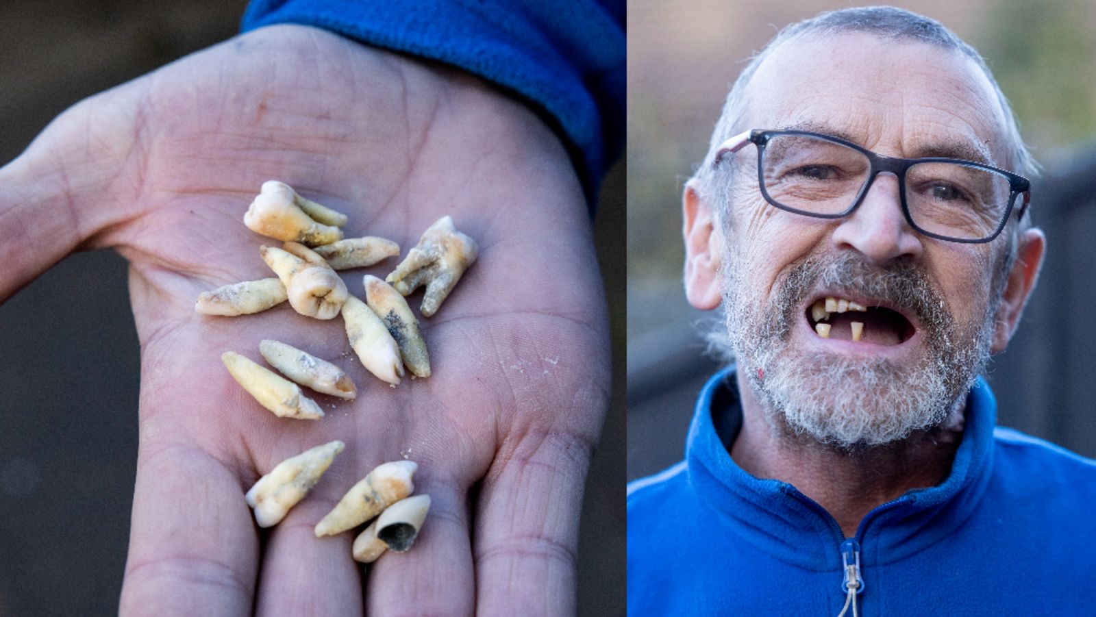 Teeth Nes Liverpool man pulls out 11 of his own teeth because he can not see NHS ...