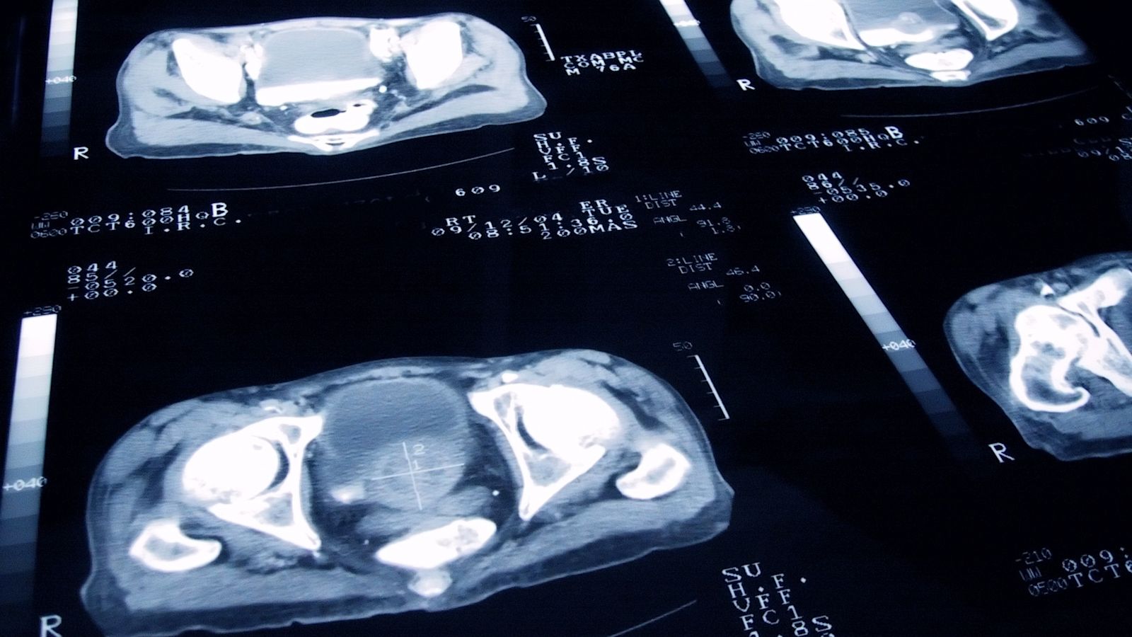 Prostate screening only for 'most at risk' men, government says