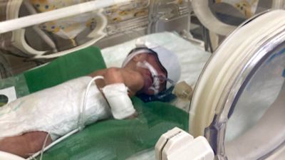 Baby Jack was born early while in Turkey weighing just a kilo.