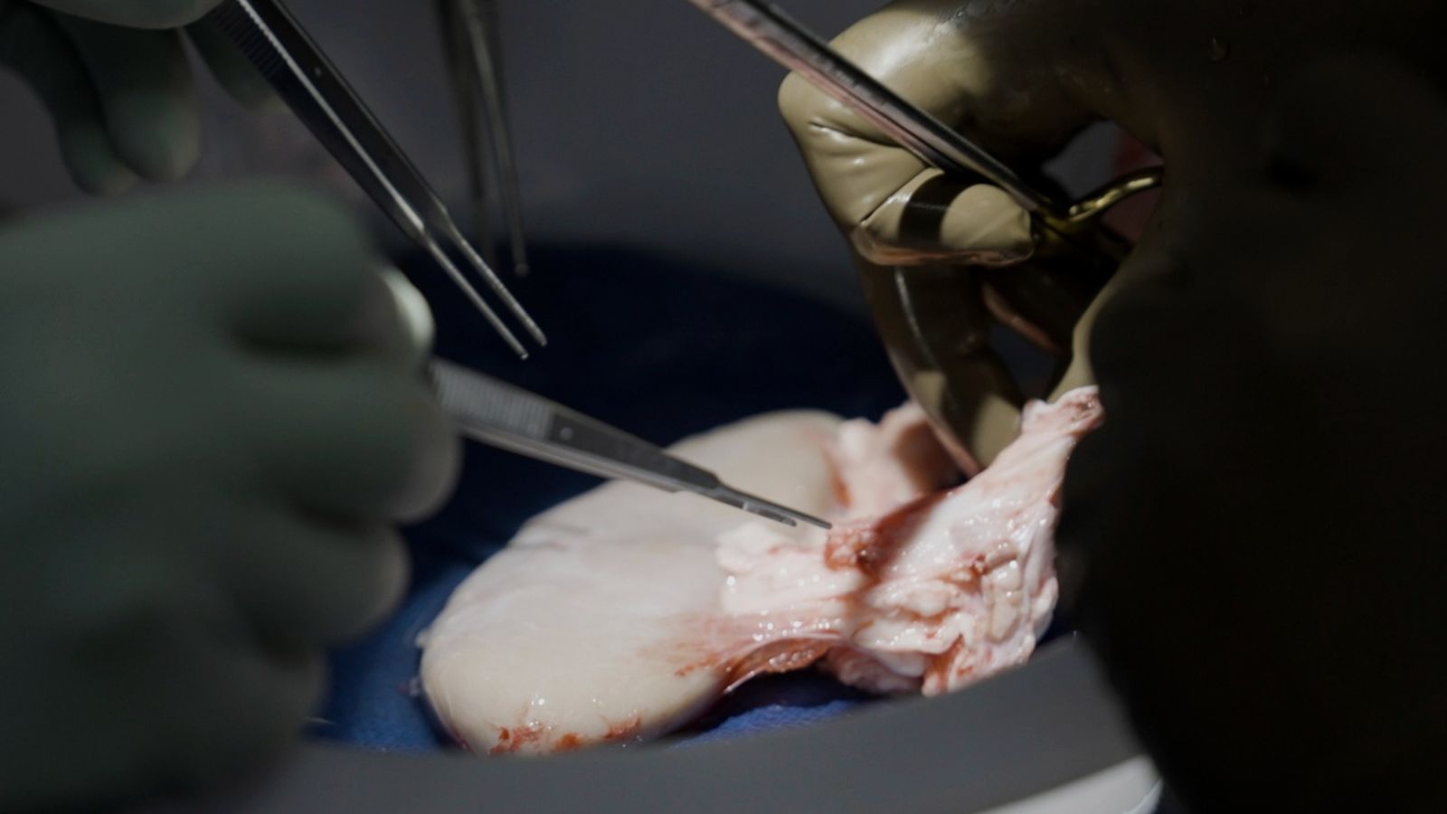 Pig kidney transplanted into human body is still working one month later