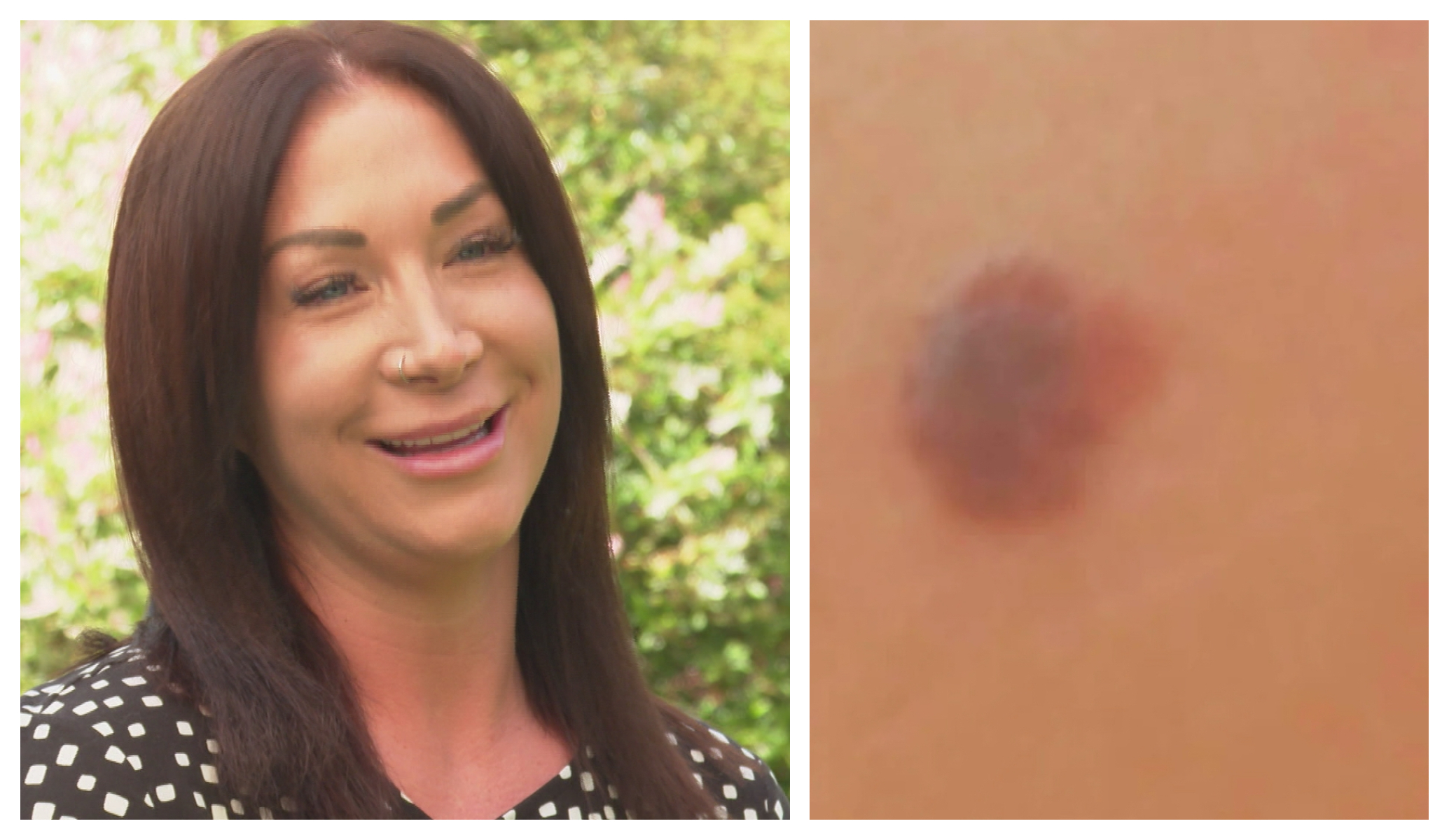 Kent mother who found daughter’s cancerous mole says ‘you saved her life’