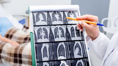 More cancer patients than ever being diagnosed at early stage