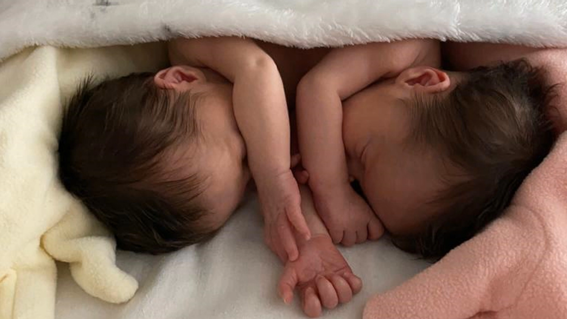 Isabelle and 2025 isadora conjoined twins