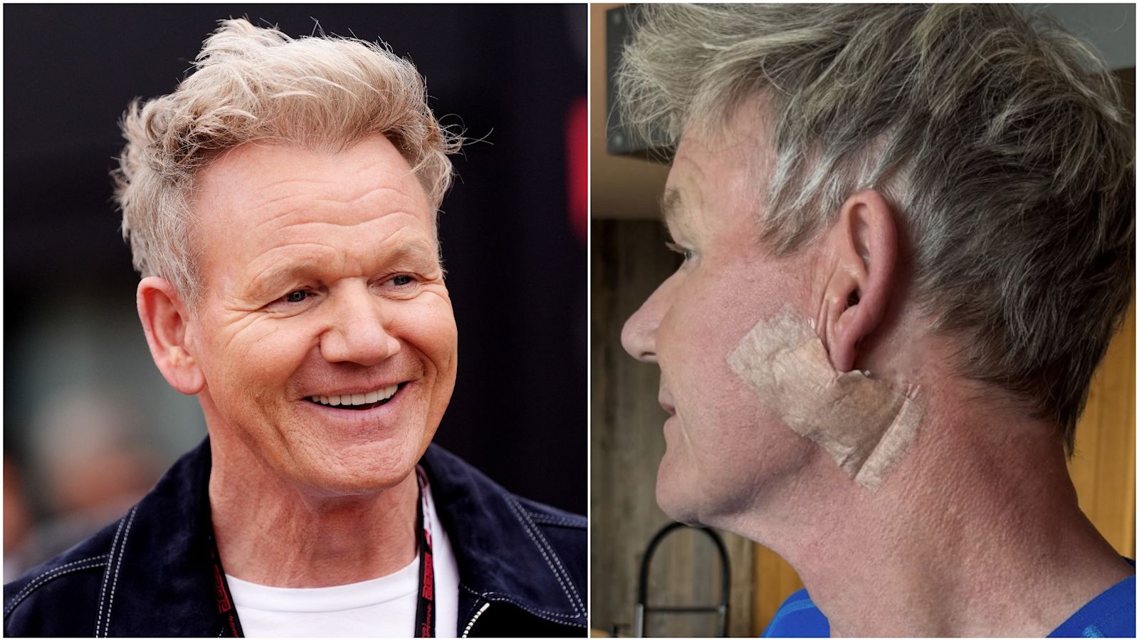 TV chef Gordon Ramsay reveals skin cancer treatment | ITV News