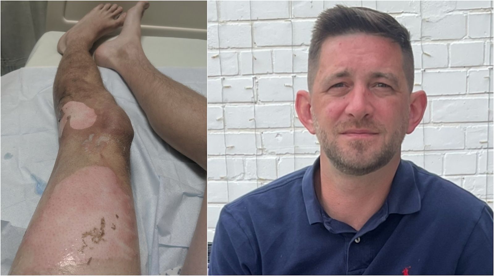 Man suffers third-degree burns after vape battery explodes in his pocket | ITV News Granada Man suffers third-degree burns after vape battery explodes in his pocket | ITV News Granada