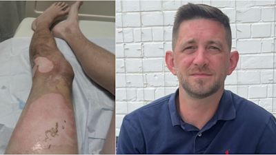 Man suffers third-degree burns after vape battery explodes in his pocket | ITV News Granada Man suffers third-degree burns after vape battery explodes in his pocket | ITV News Granada