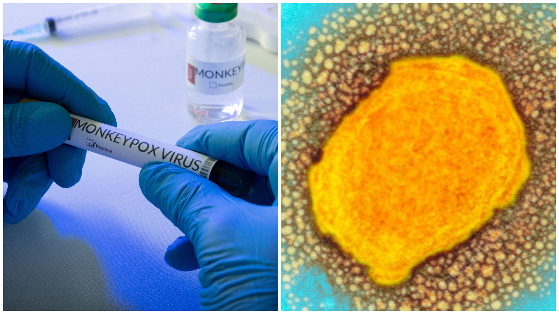 Tpoxx: Oxford scientists behind Covid breakthrough start first monkeypox treatment study