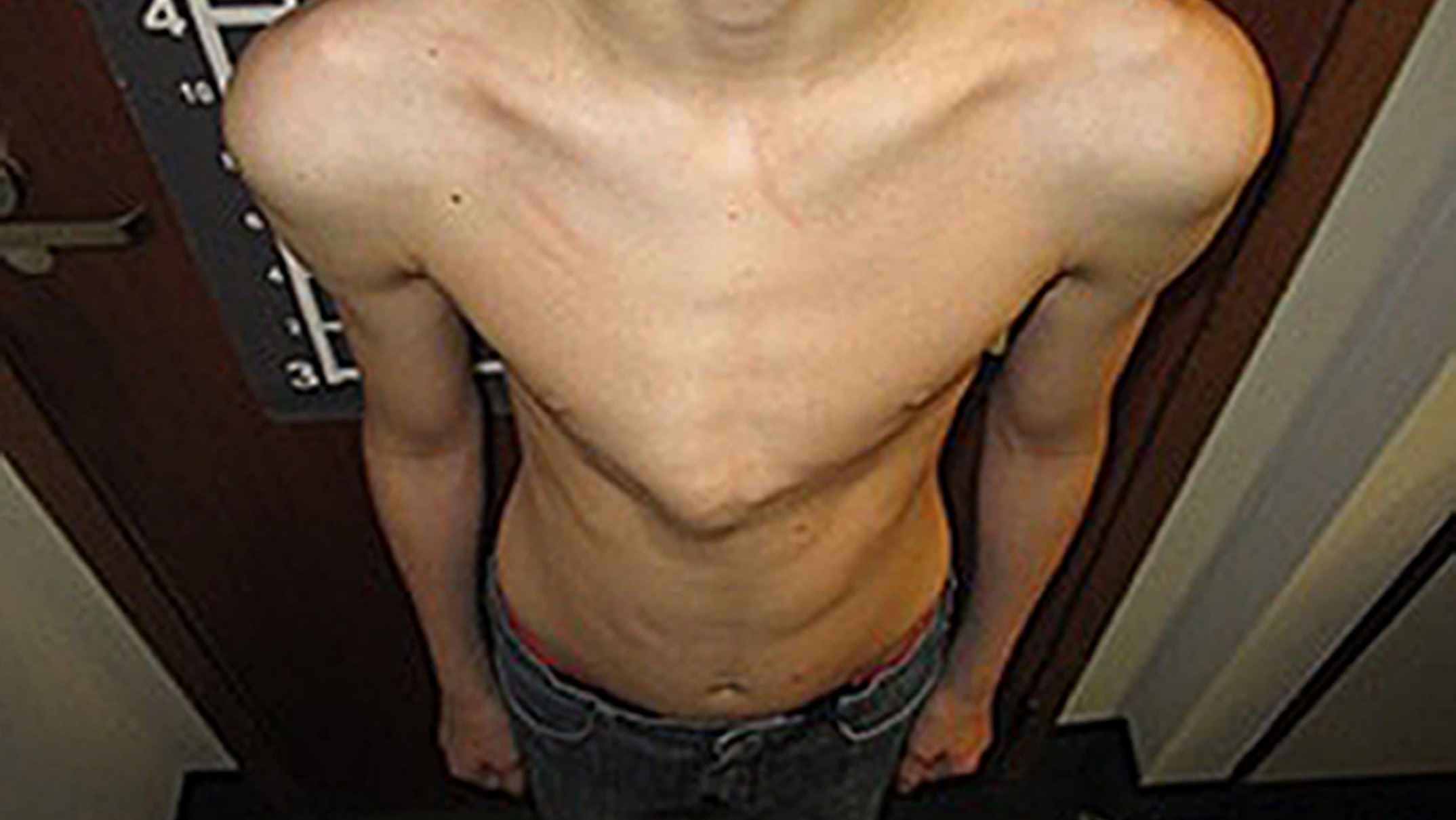 воронкообразная грудь у мужчин фото 49