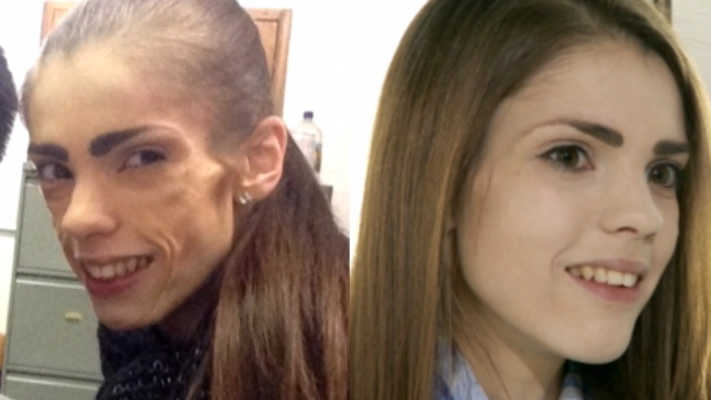 'Anorexia took everything away from me' | ITV News Channel