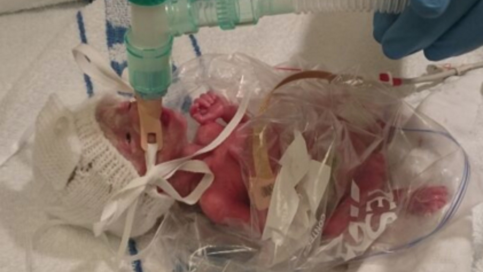 The baby saved by a plastic bag | ITV News West Country