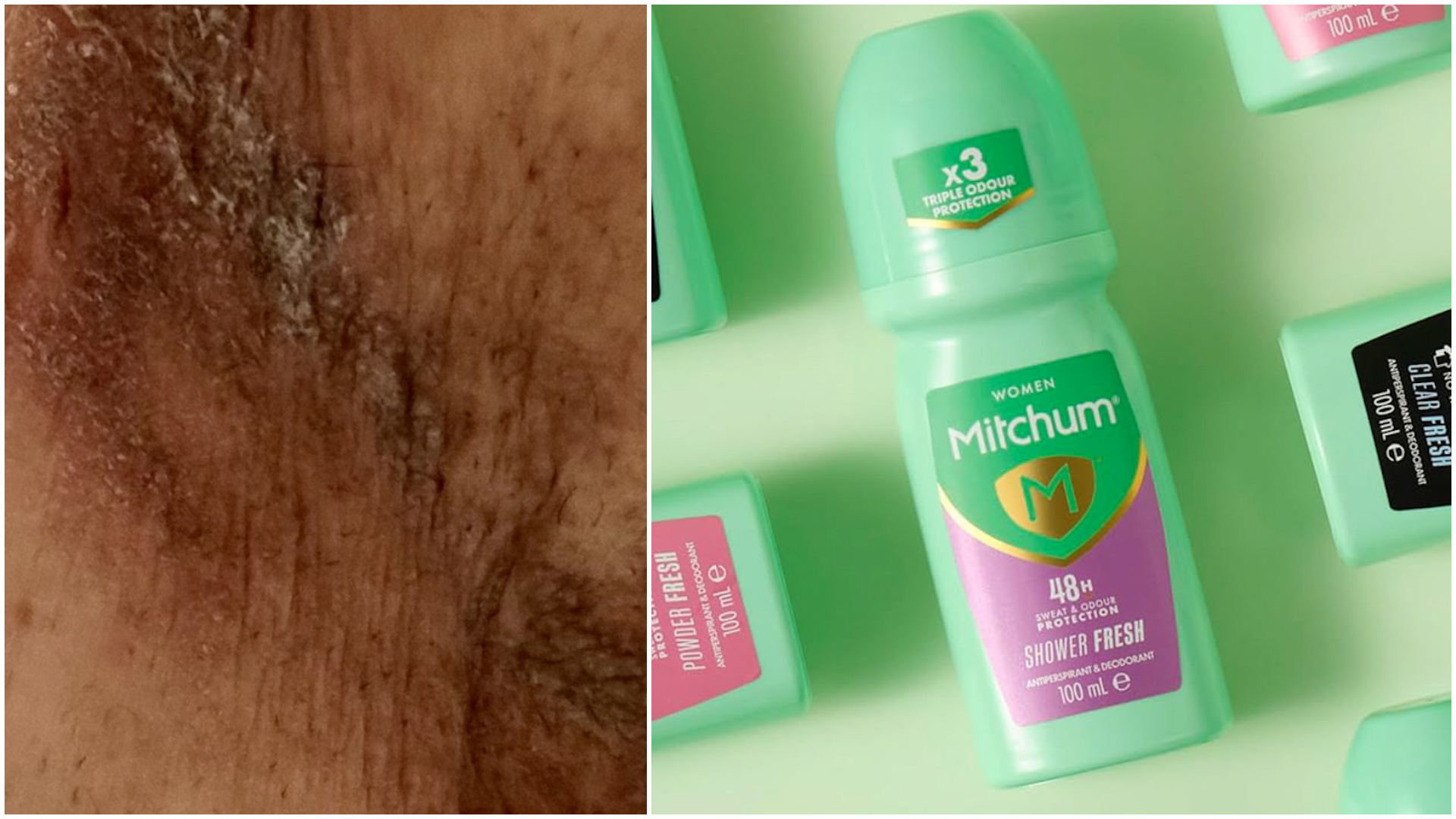 Women sue Mitchum deodorant after 'permanent scarring'