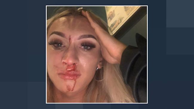 Transgender woman Anna Montgomery was left bloodied and bruised after being attacked and punched repeatedly in the face in a restaurant in Belfast in what police are investigating as a hate crime.