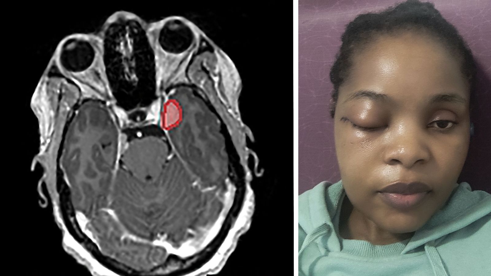 UK-first operation to remove brain tumour through eye socket performed ...