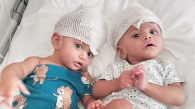 UK neurosurgeon leads first-of-its kind surgery to separate conjoined twins