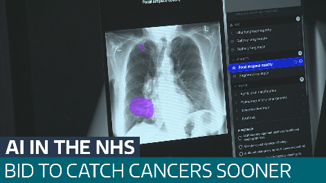 AI in the NHS: lung scanning technology being used in bid to save lives ...