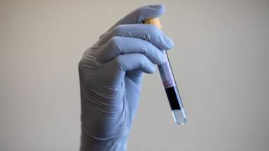 England on track to eliminate hepatitis C, health officials say