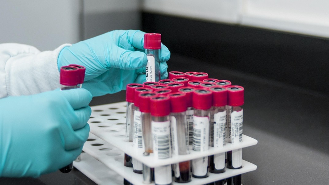 Scientists develop first-ever blood test for chronic fatigue syndrome