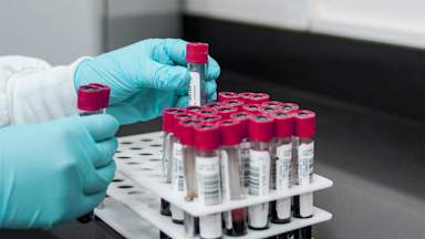 Scientists develop first-ever blood test for chronic fatigue syndrome