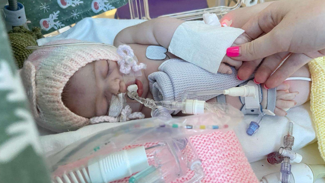 Lab-grown mini-lungs could help treat rare condition in babies