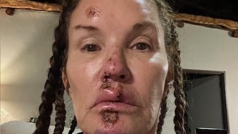 Janice Dickinson sues ITV after claim I'm A Celeb fall caused facial scarring