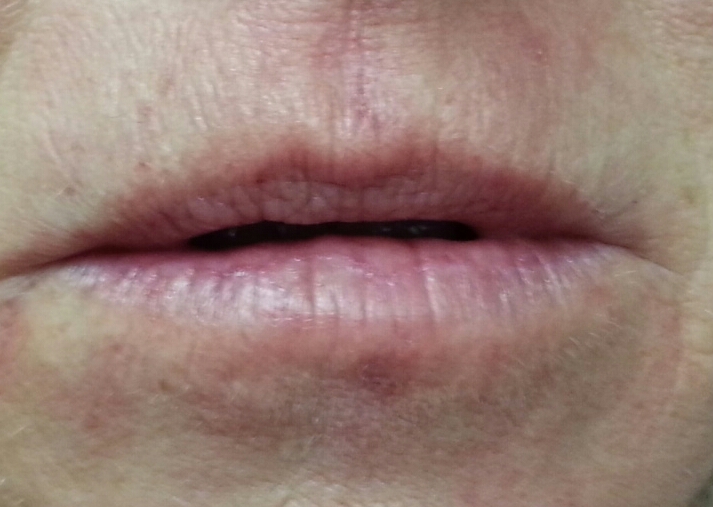 Immediately after 1cc Restylane