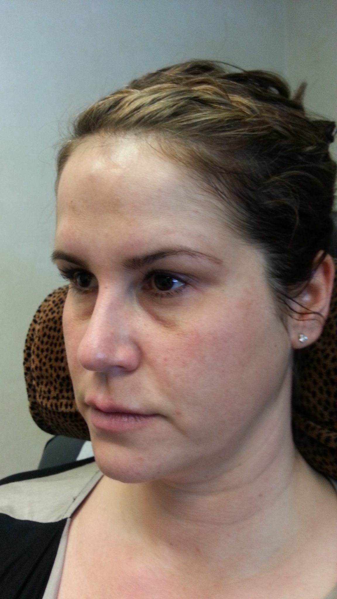 Before 2 cc’s Restylane in the tear troughs and 3 cc’s Restylane Lyft in the cheeks, corners of the mouth, and jowls.