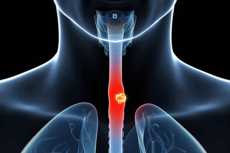 Esophageal cancer – What does the diagnosis mean?