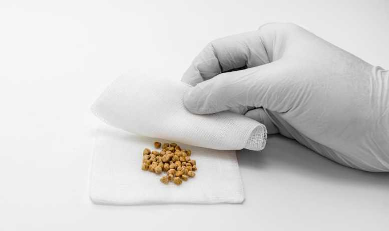 Gallstones: The most important things at a glance