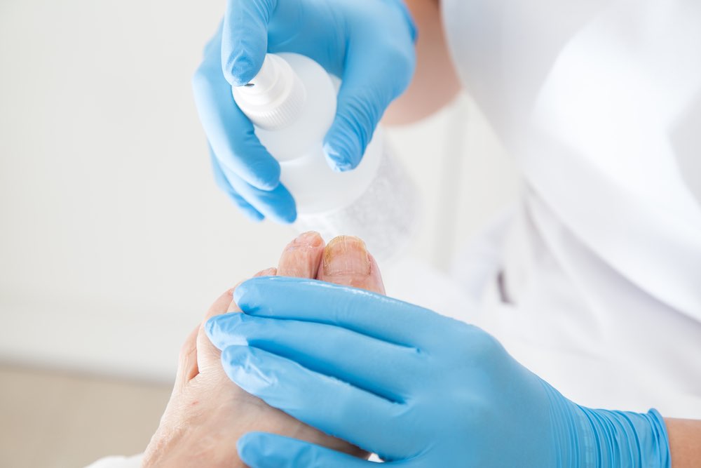 nystatin-zur-bekampfung-von-hefepilz-infektionen