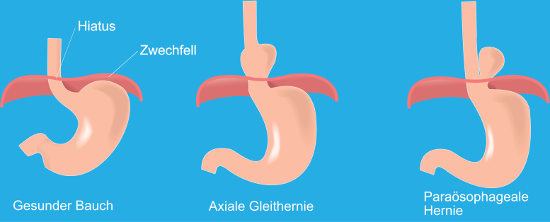 Diaphragmatic (hiatal) hernias: All you need to know