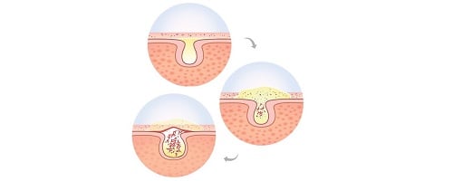 Acné: Descubre todo lo que deberías saber - Image 3 - Neutrogena - es-ES