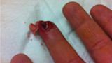 Partially severed bloody middle fingertip with exposed tissue resting on white gauze
