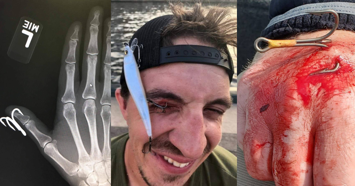 Photos: The Worst Fish Hook Injuries to MeatEater Fans | MeatEater Fishing Photos: The Worst Fish Hook Injuries to MeatEater Fans | MeatEater Fishing
